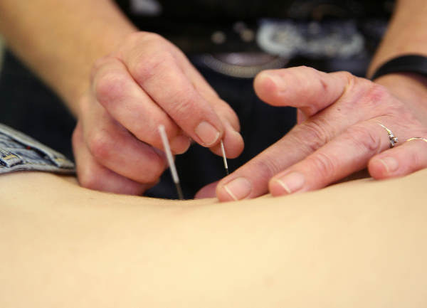 \"acupuncturist(e) die naalden zet bij een patië®´(e)\"