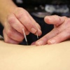 \"acupuncturist(e) die naalden zet bij een patië®´(e)\"